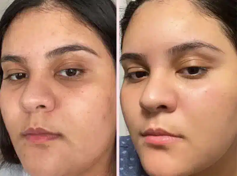 gingembre bienfait sur le visage