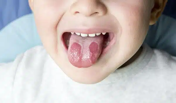 langue blanc et rouge