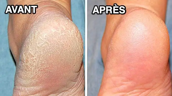 AVANT ET APRès talons fissurés