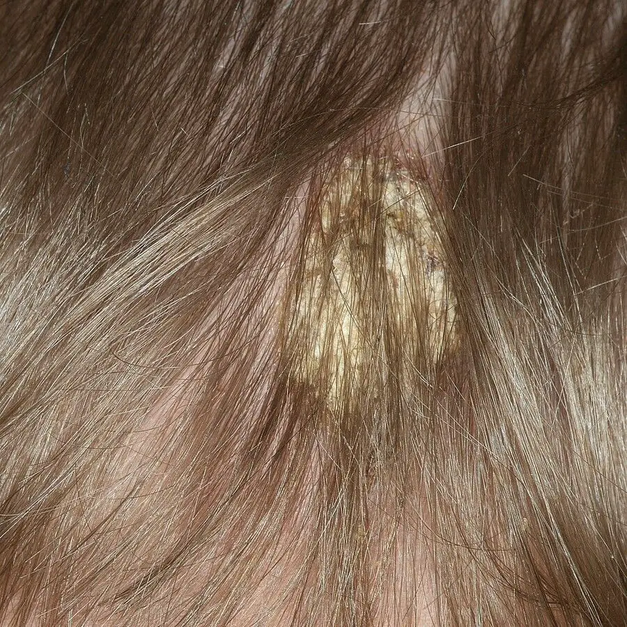 remede contre teigne-min